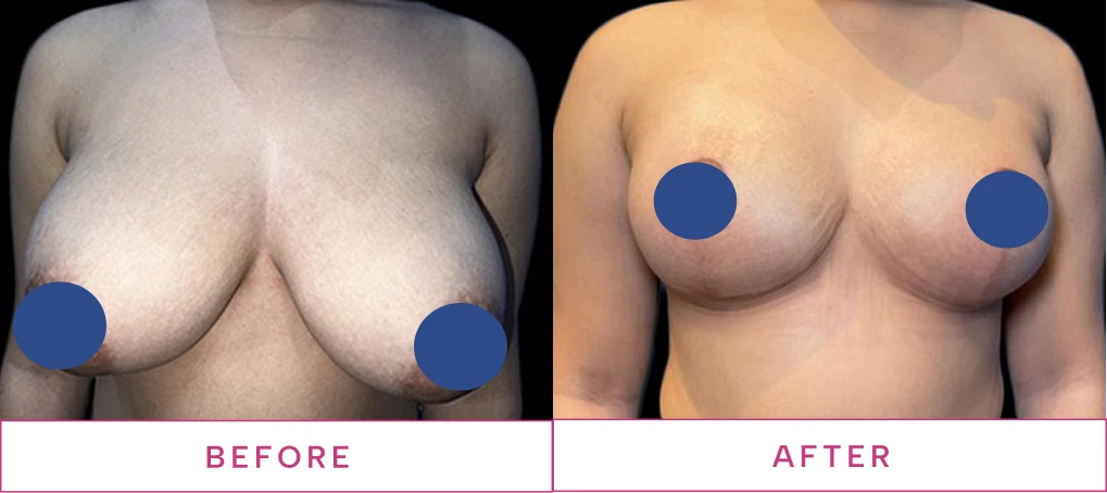 Breast Reduction Before & After image2 (1)