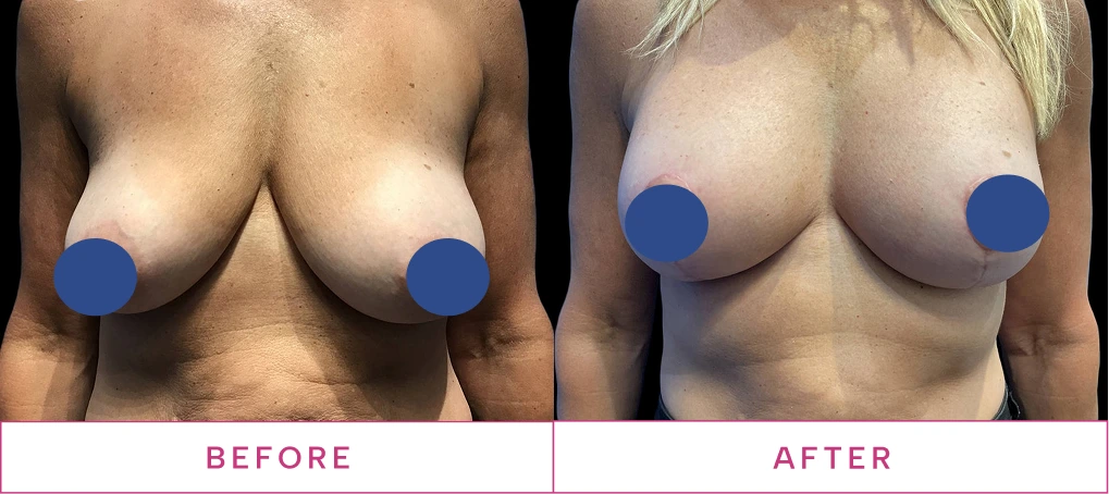 Breast Reduction Before & After image2 (2)
