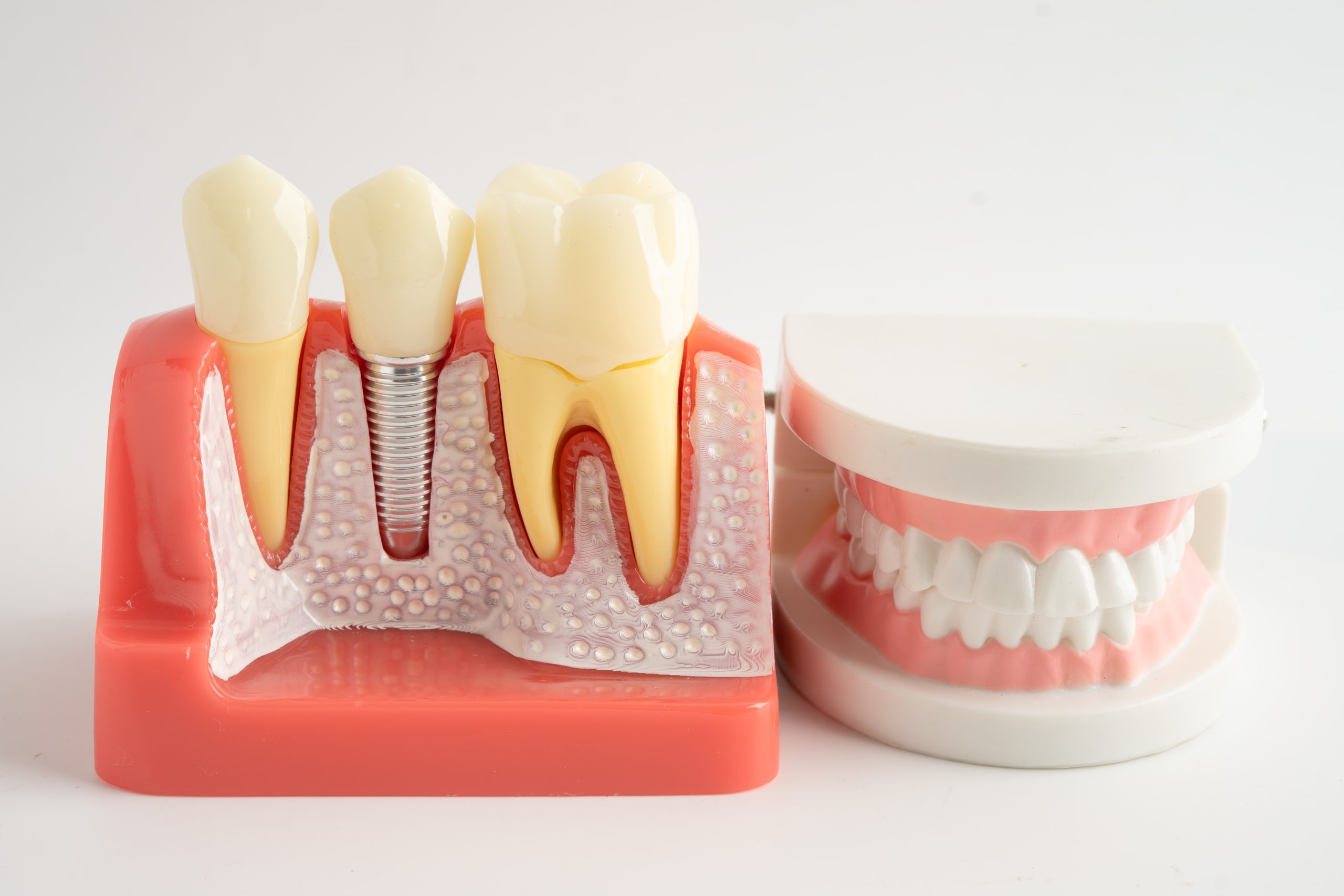 Dental Implants vs. Dentures: Which Is Best for You? Banner