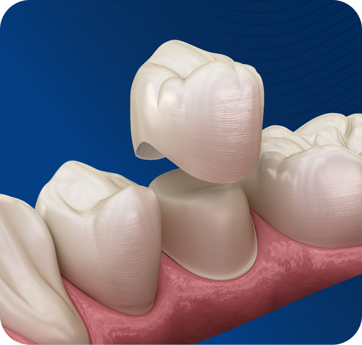 3D illustration of three dental crowns on pink gum tissue against blue background