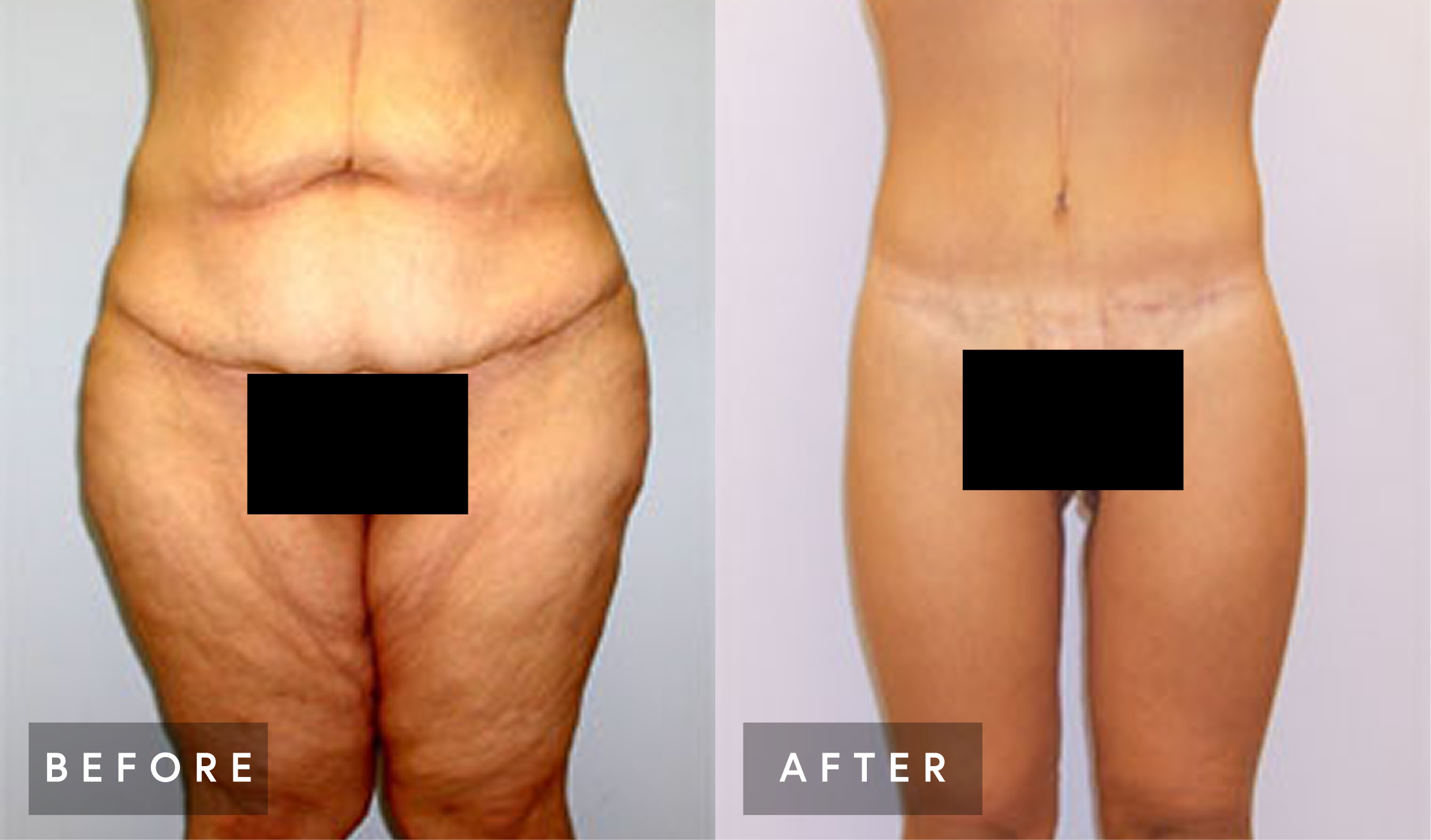Before and after body lift results showing front torso with reduced laxity and improved abdominal definition