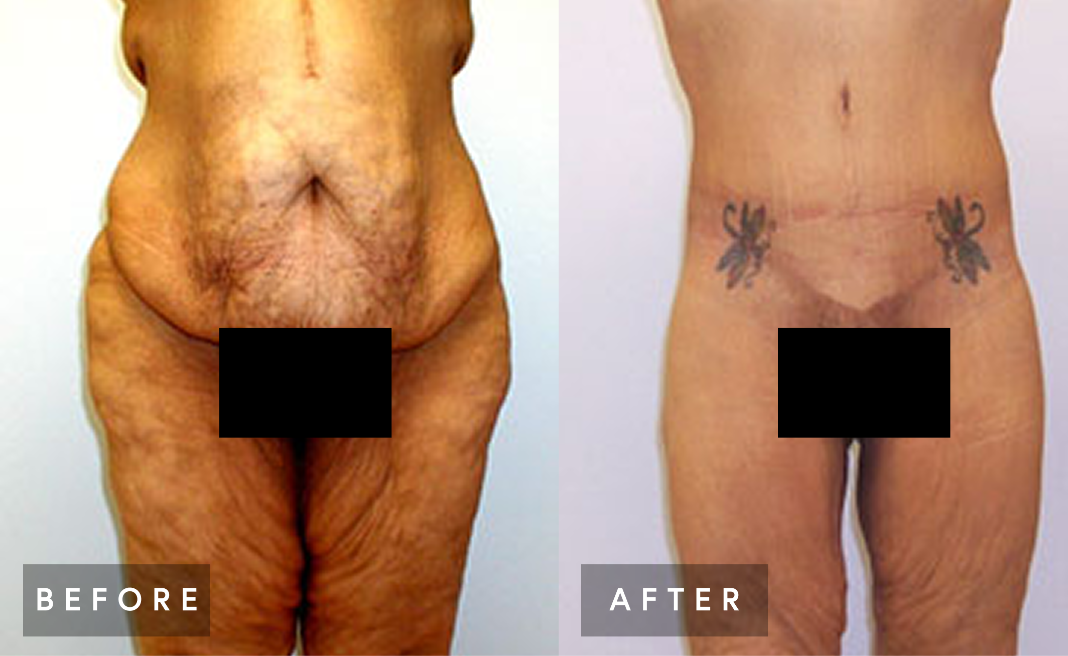 Before and after body lift results showing front lower body with improved skin tightness and body contour