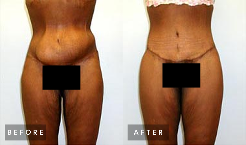 Before and after comparison of abdominal and body contouring procedure results