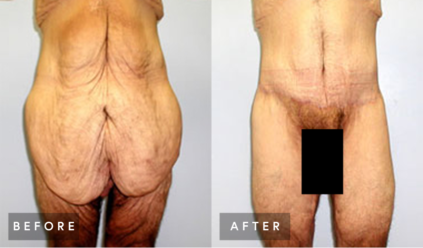 Before and after comparison of body lift results, showing improved skin tightness and contour