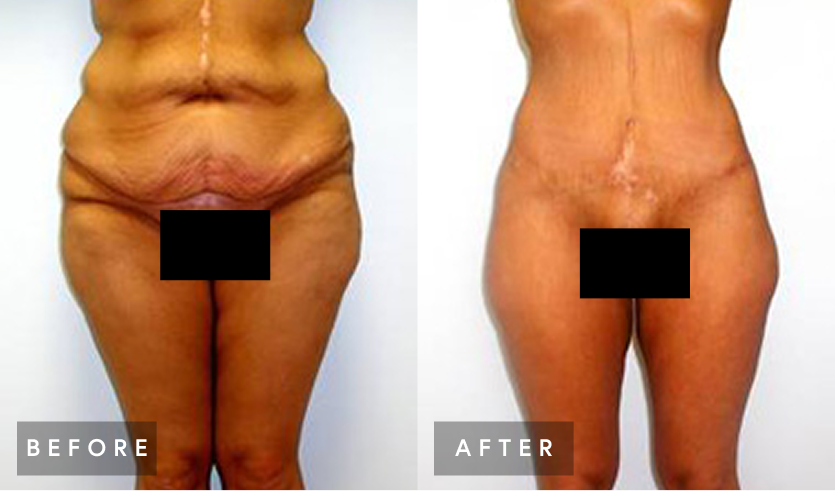 Before and after comparison of body contouring results, showing reduced abdominal and thigh appearance
