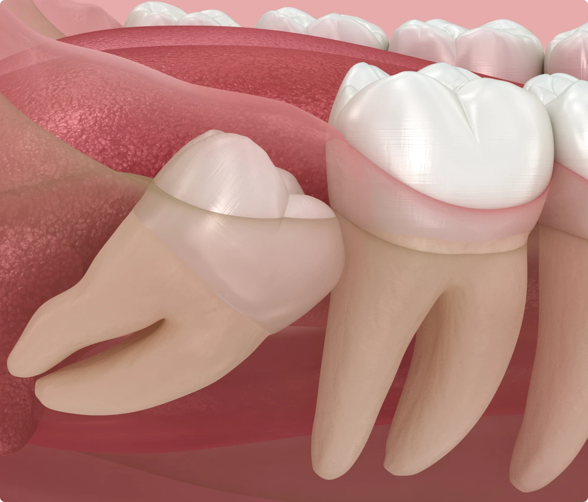 Wisdom Teeth Removal in Denver Banner