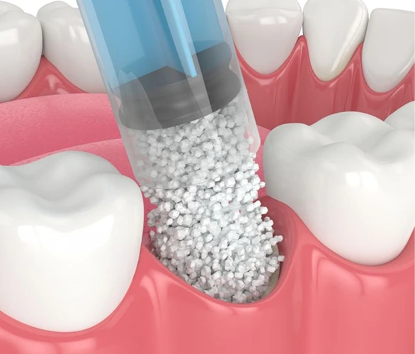 Bone Graft in Denver, CO: What Is a Bone Graft? Banner