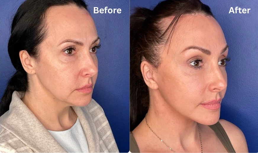 Facelift (2)