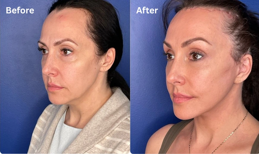 Facelift (3)