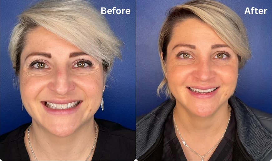 Rhinoplasty (10)