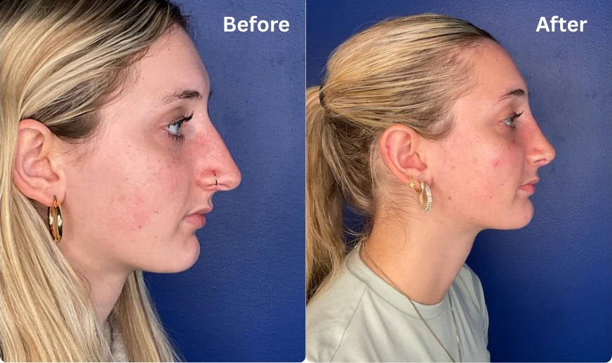 Rhinoplasty (101)