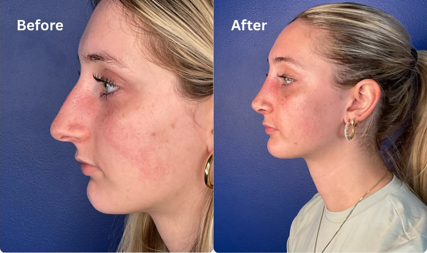 Rhinoplasty (102)