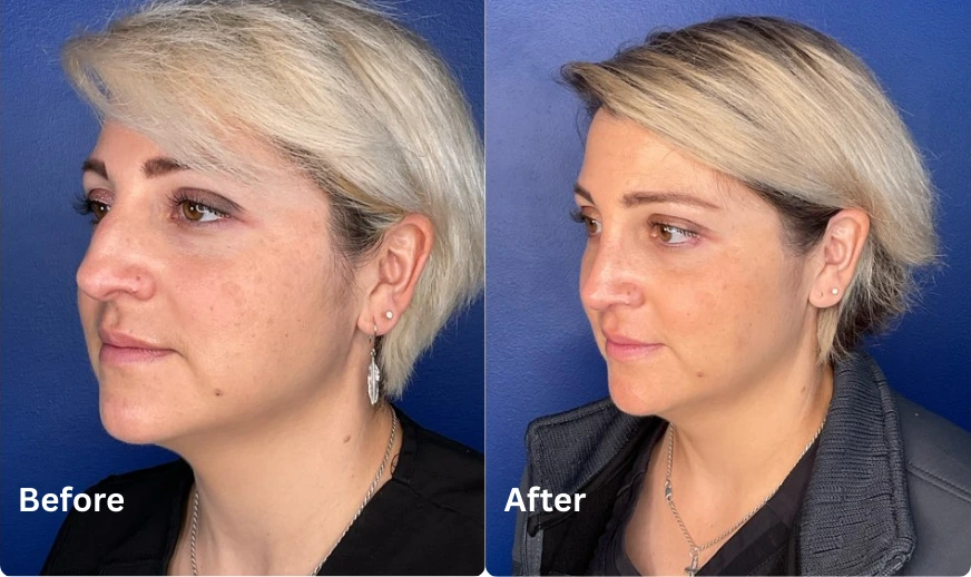 Rhinoplasty (11)