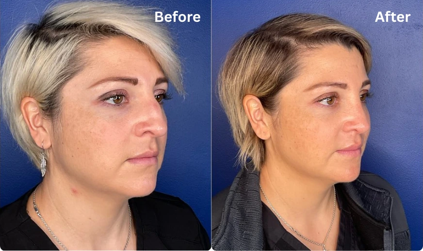 Rhinoplasty (12)