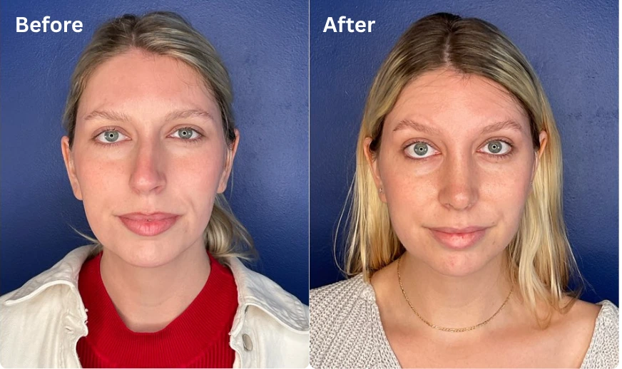 Rhinoplasty (13)