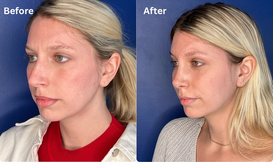 Rhinoplasty (15)