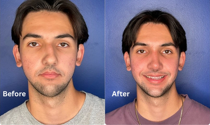 Rhinoplasty (7)