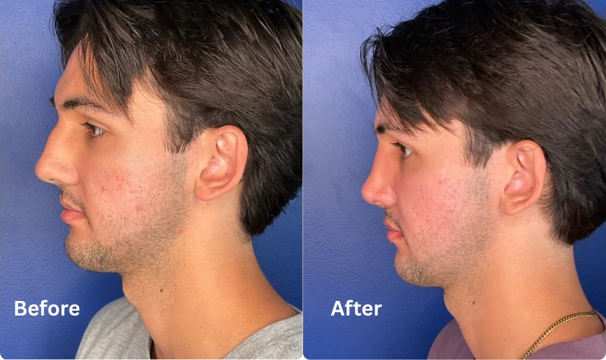Rhinoplasty (9)