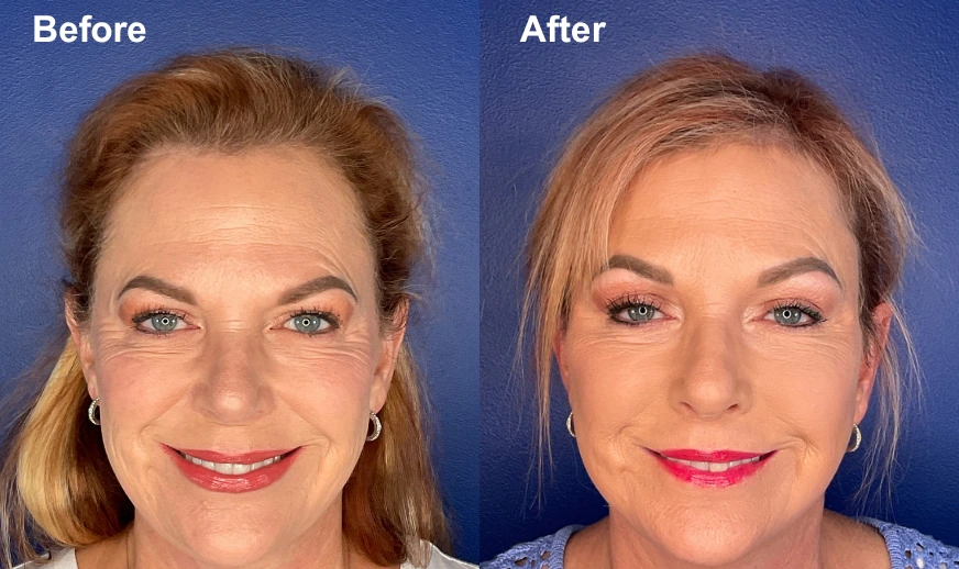 Before and after frontal views showing facial rejuvenation with improved skin texture