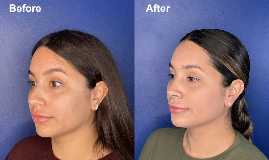 Before and after profile view showing facial contouring results