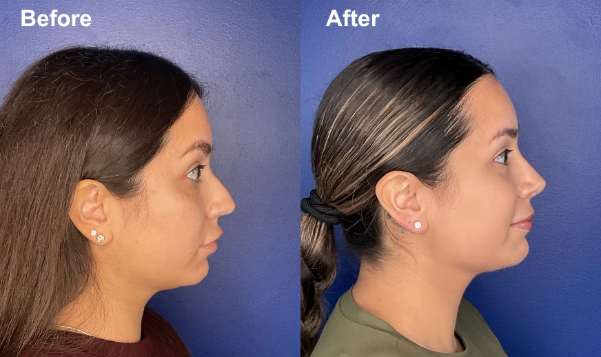 Before and after profile view showing chin augmentation and jaw enhancement