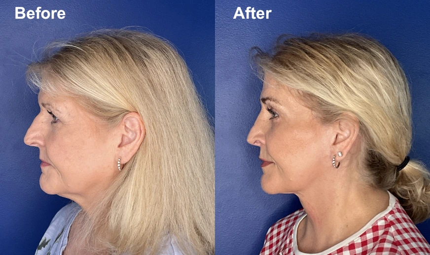 Before and after profile view of facelift results with improved neck contour