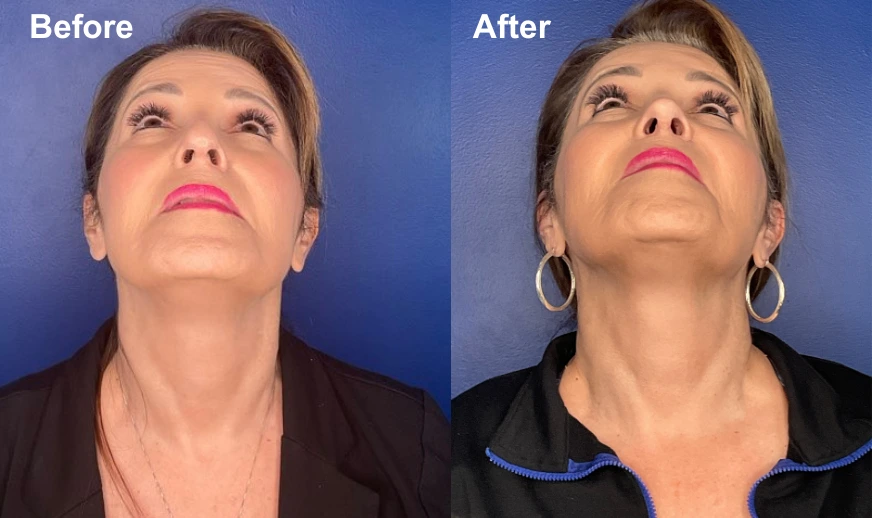 Before and after photos from below showing chin and neck contouring results
