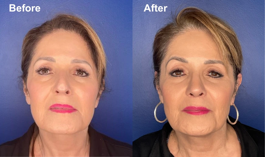 Before and after front-facing photos showing facial rejuvenation results