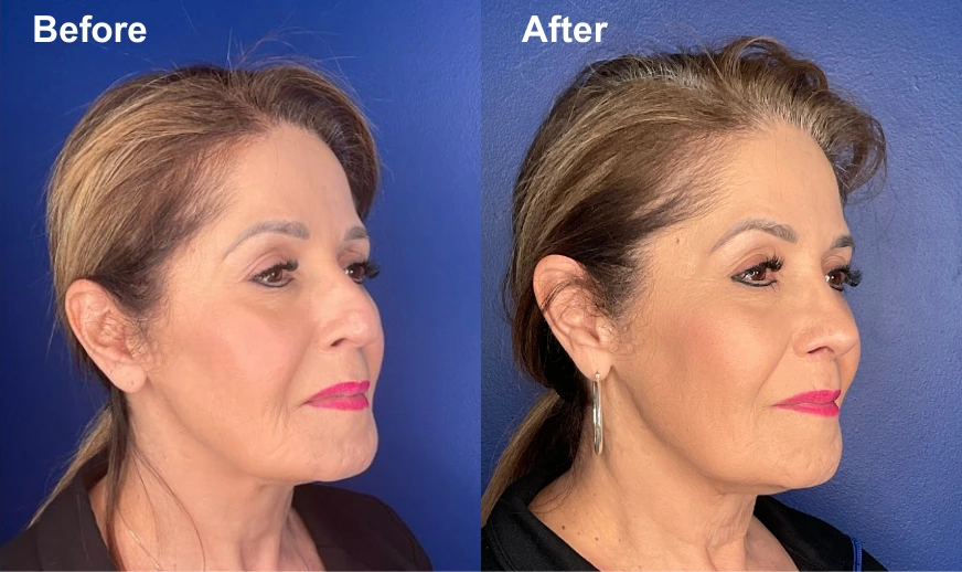Before and after profile comparison showing a woman's side profile facing right