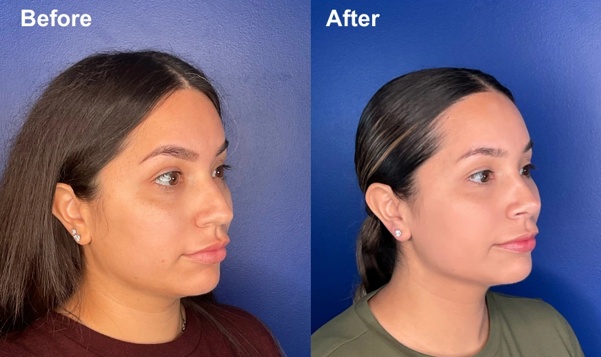 Before and after profile comparison showing a woman's side profile facing left