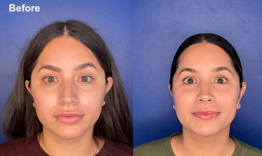 Before and after frontal facial comparison showing a woman's face at rest