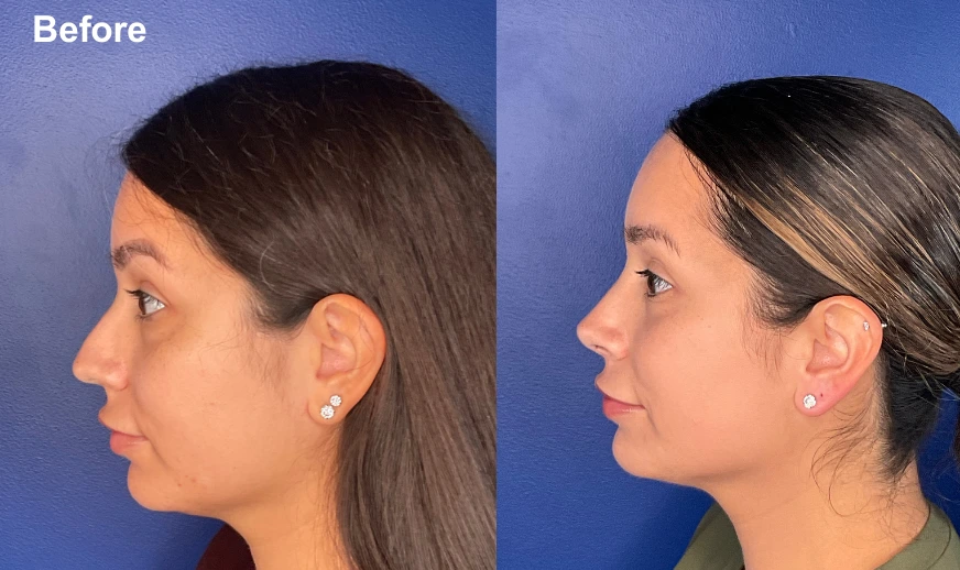 Before and after profile comparison showing a woman's side profile