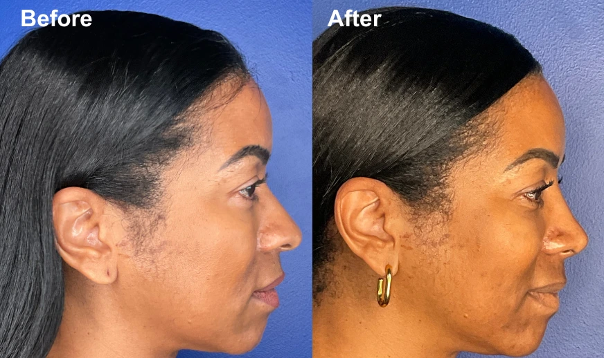 Before and after rhinoplasty profile views showing refined nose and improved facial balance
