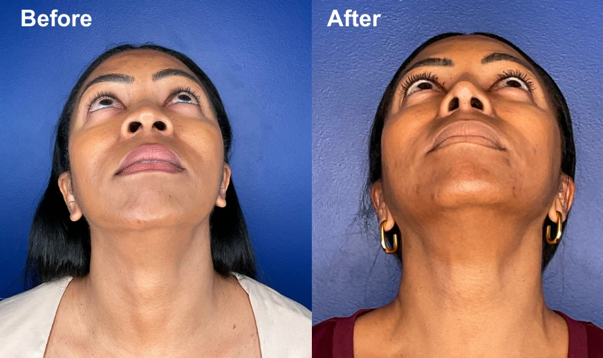 Before and after upward-facing photos showing chin augmentation results