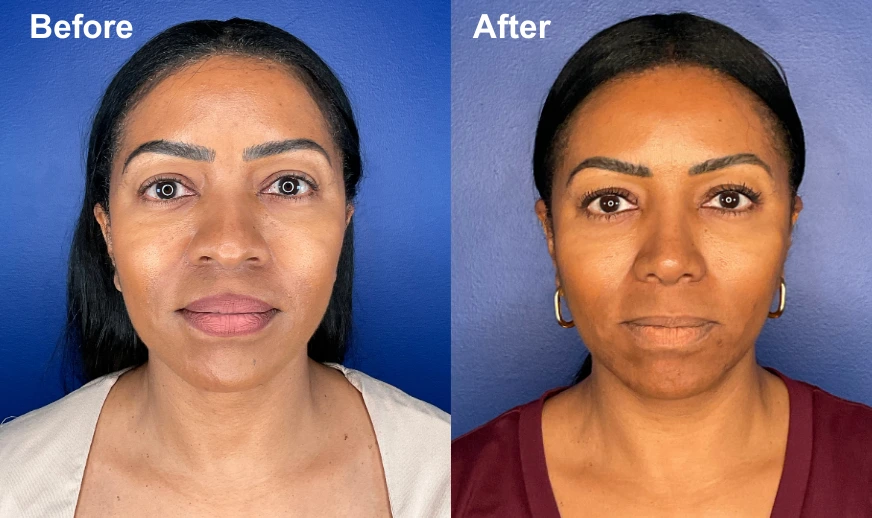 Before and after facial photos showing front-facing comparison of patient results
