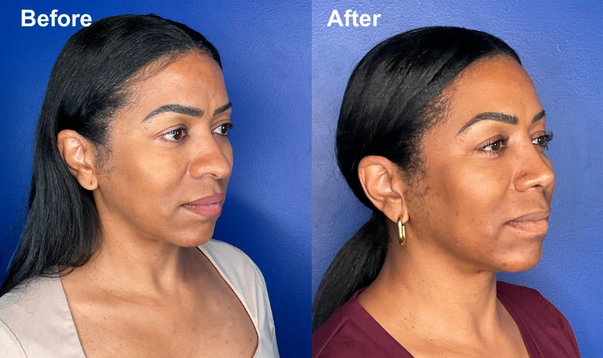 Before and after profile view comparison showing patient facial results from the side