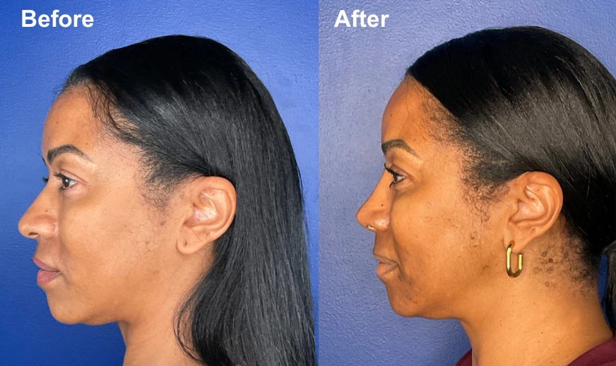 Before and after profile photos showing rhinoplasty results