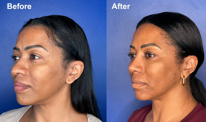 Before and after profile photos showing nose reshaping results