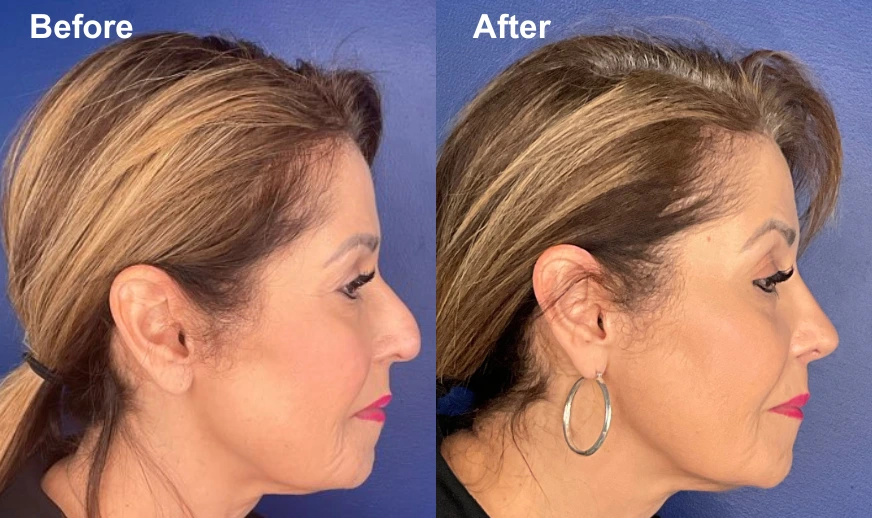 Before and after rhinoplasty profile views showing refined nasal structure and improved profile