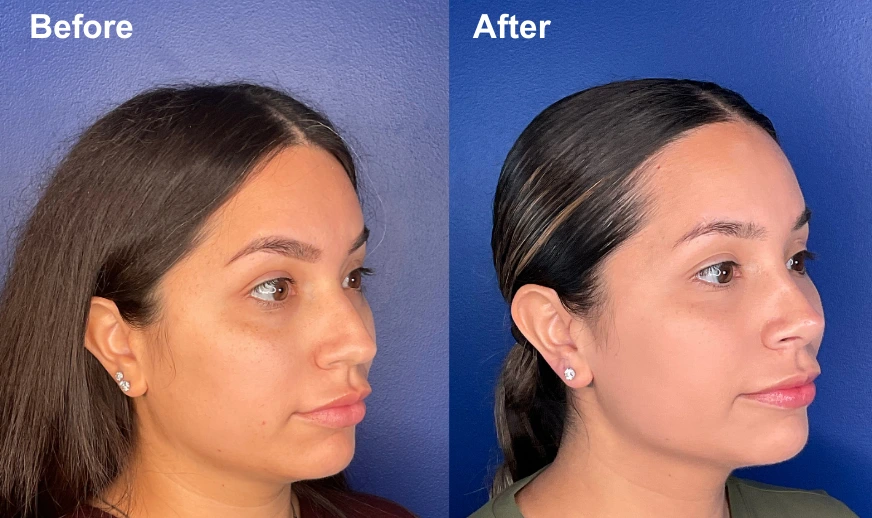 Before and after rhinoplasty profile views showing refined nose shape and improved facial proportion