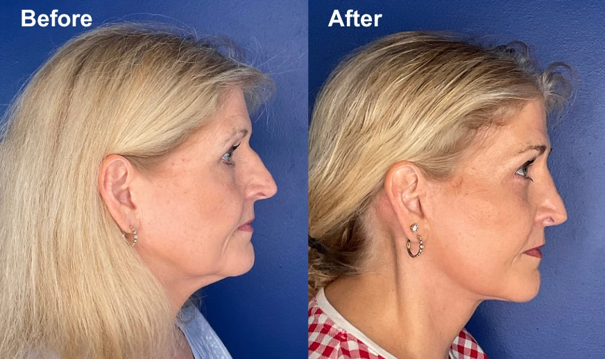 Before and after rhinoplasty profile views showing refined nasal bridge and improved contour