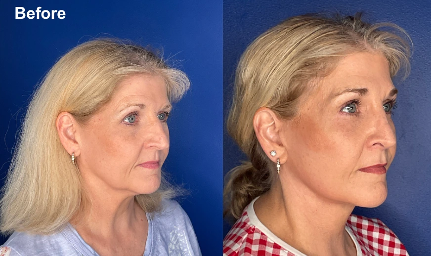 Before and after profile view comparison showing patient facial results from the side