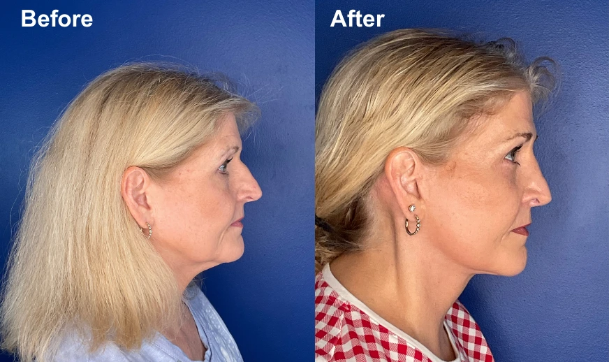 Before and after profile views of facelift results showing improved jawline and neck definition