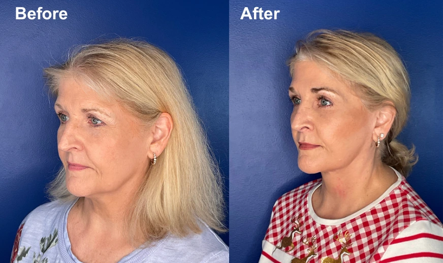 Before and after profile comparison of facelift patient with lifted facial contours and reduced sagging
