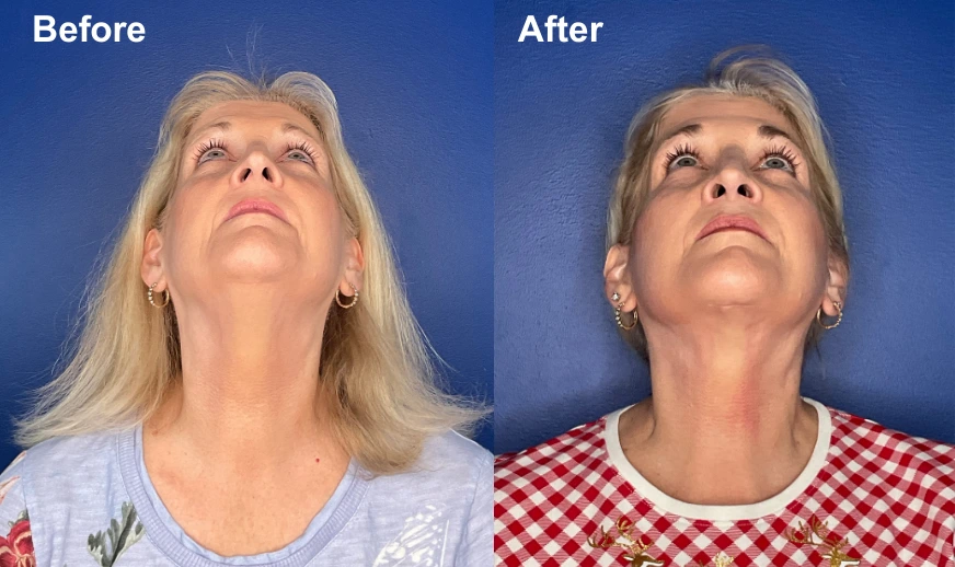 Before and after upward-facing photos showing patient results from below
