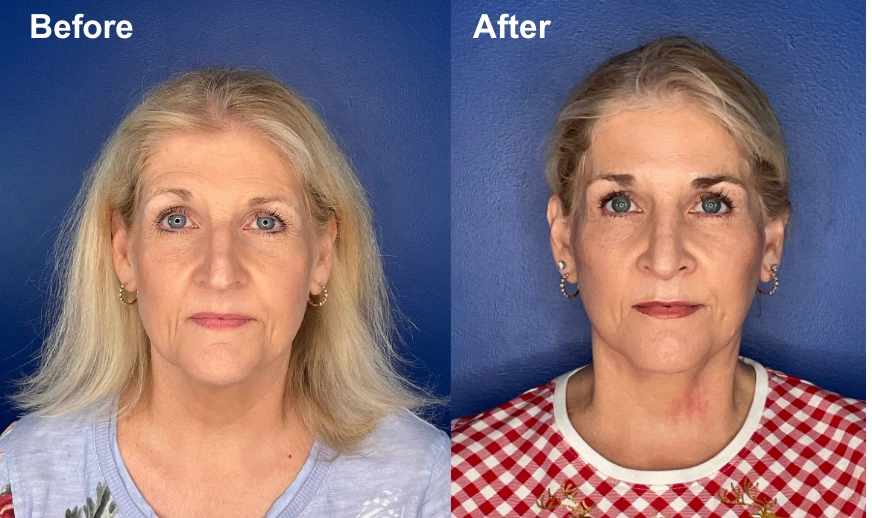 Before and after front-facing photos showing patient facial results