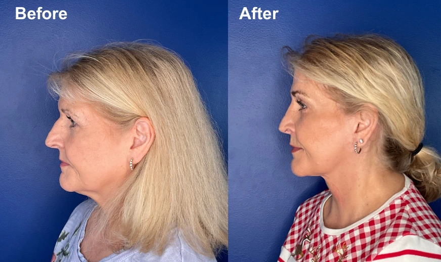 Before and after profile view comparison showing patient results from the side