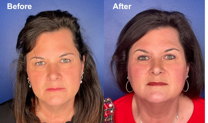 Before and after frontal views showing facial lift and rejuvenation results