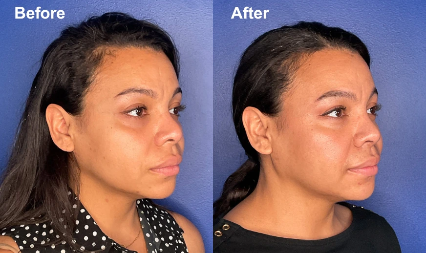 Before and after profile view showing facial contour refinement