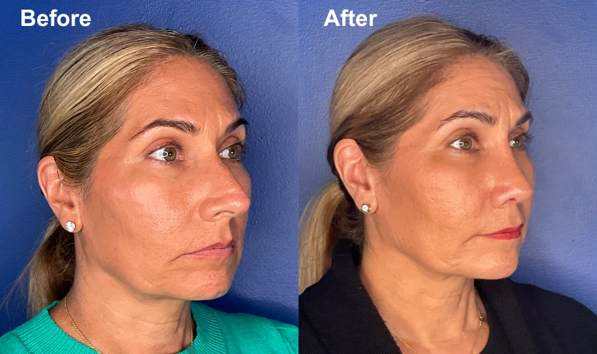 Before and after profile view showing jawline and chin definition